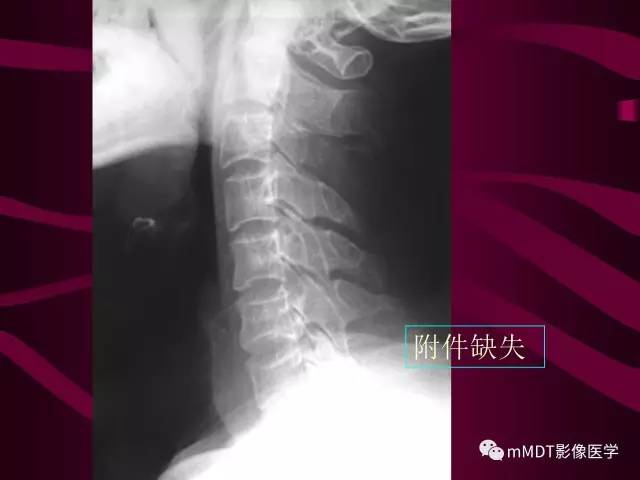 【PPT】骨转移瘤的少见表现