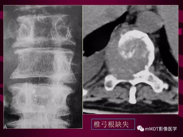 【PPT】骨转移瘤的少见表现