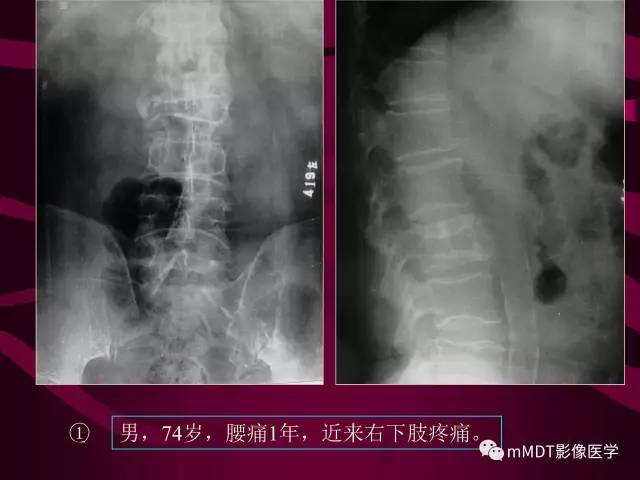 【PPT】骨转移瘤的少见表现