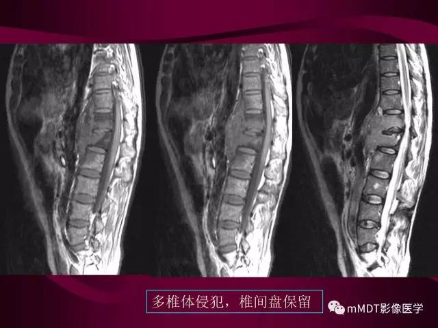 【PPT】骨转移瘤的少见表现