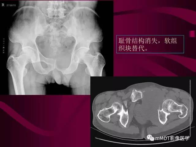 【PPT】骨转移瘤的少见表现