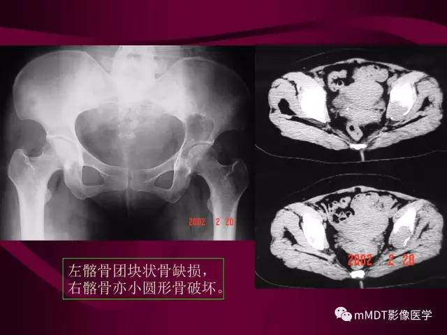 【PPT】骨转移瘤的少见表现