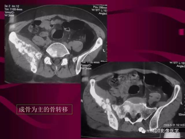 【PPT】骨转移瘤的少见表现