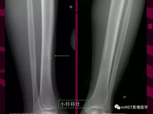 【PPT】骨转移瘤的少见表现