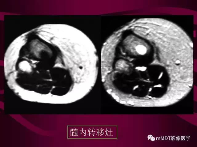 【PPT】骨转移瘤的少见表现