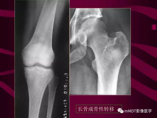 【PPT】骨转移瘤的少见表现