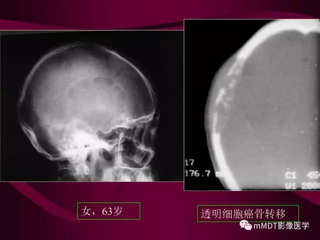 【PPT】骨转移瘤的少见表现