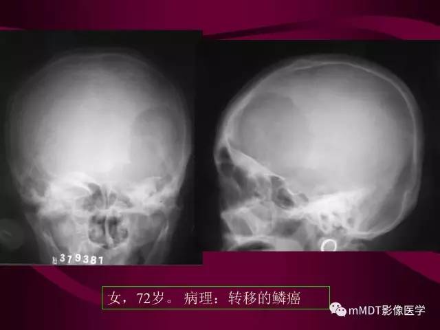 【PPT】骨转移瘤的少见表现