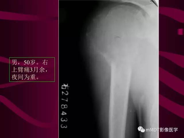 【PPT】骨转移瘤的少见表现