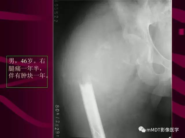 【PPT】骨转移瘤的少见表现