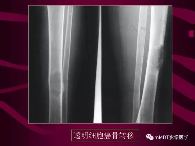 【PPT】骨转移瘤的少见表现