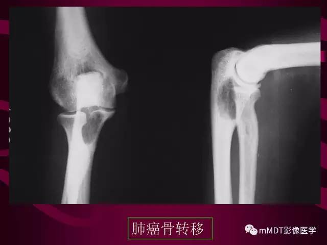 【PPT】骨转移瘤的少见表现