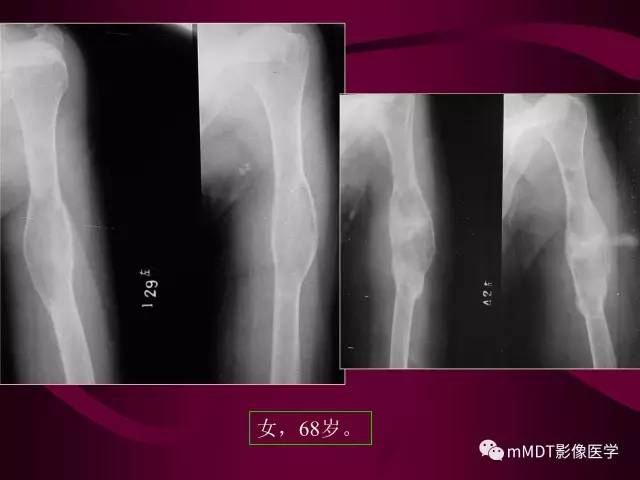 【PPT】骨转移瘤的少见表现