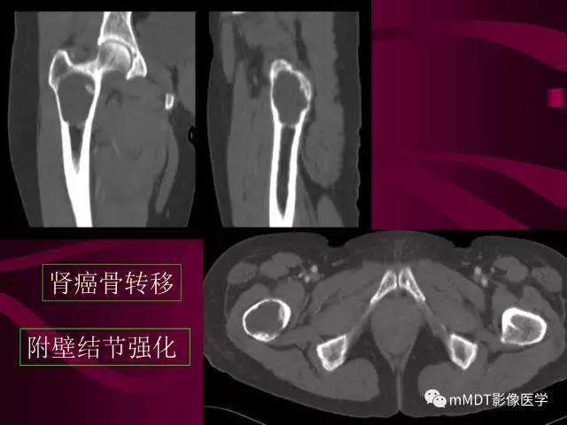 【PPT】骨转移瘤的少见表现
