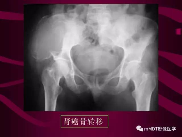 【PPT】骨转移瘤的少见表现