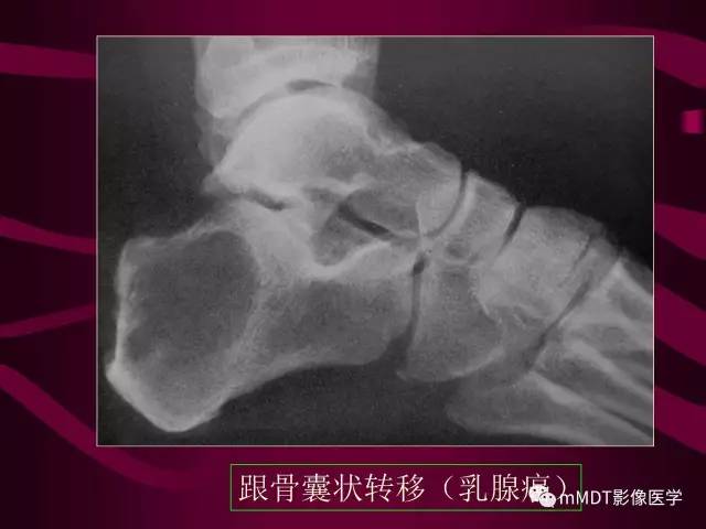 【PPT】骨转移瘤的少见表现