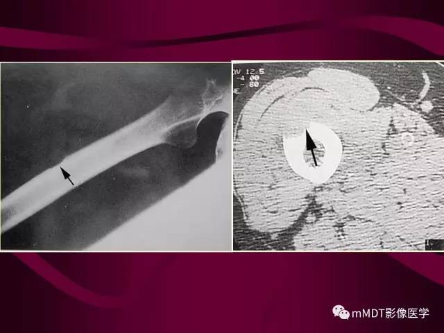 【PPT】骨转移瘤的少见表现