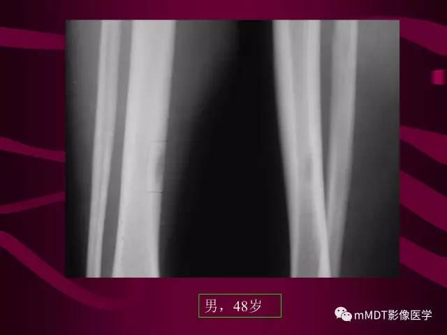 【PPT】骨转移瘤的少见表现