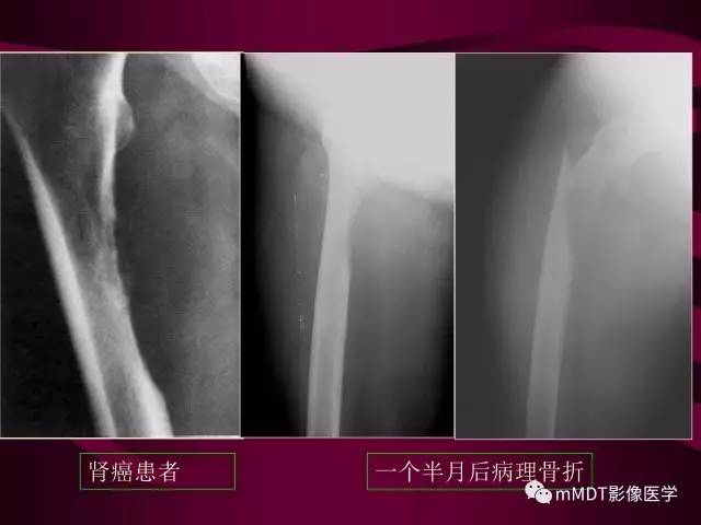 【PPT】骨转移瘤的少见表现