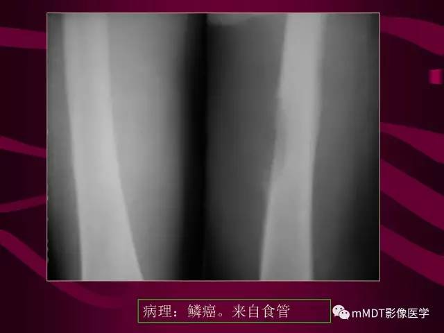 【PPT】骨转移瘤的少见表现