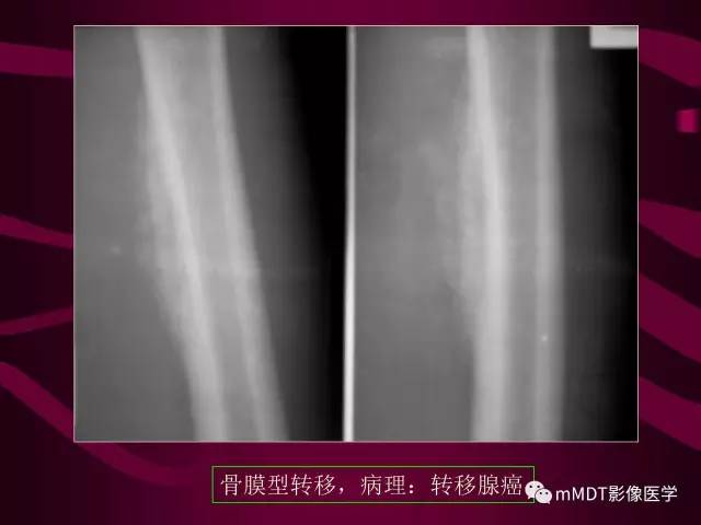 【PPT】骨转移瘤的少见表现