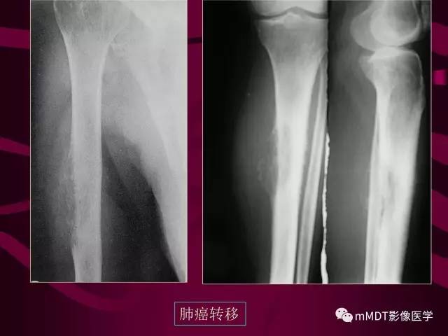 【PPT】骨转移瘤的少见表现