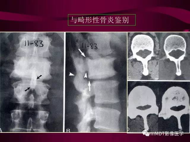 【PPT】骨转移瘤的少见表现