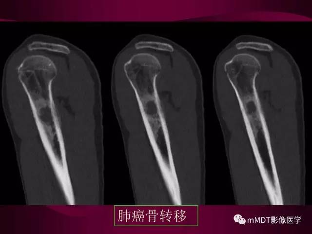 【PPT】骨转移瘤的少见表现