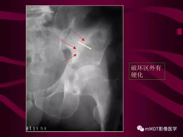 【PPT】骨转移瘤的少见表现