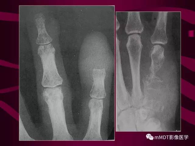 【PPT】骨转移瘤的少见表现