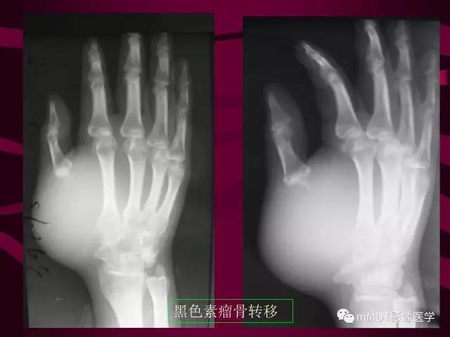 【PPT】骨转移瘤的少见表现
