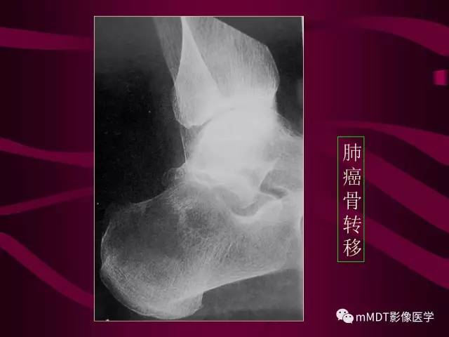【PPT】骨转移瘤的少见表现
