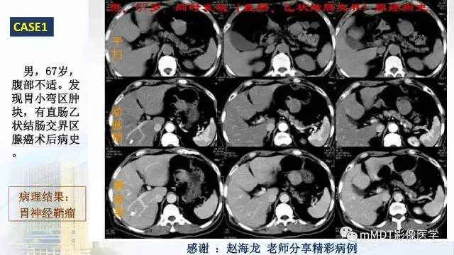 【PPT】胃神经鞘瘤