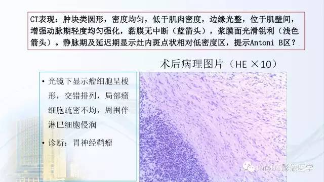 【PPT】胃神经鞘瘤