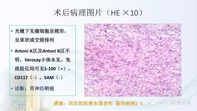 【PPT】胃神经鞘瘤