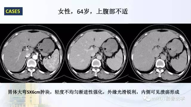 【PPT】胃神经鞘瘤