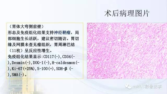 【PPT】胃神经鞘瘤