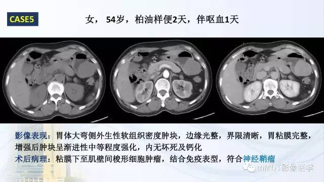 【PPT】胃神经鞘瘤