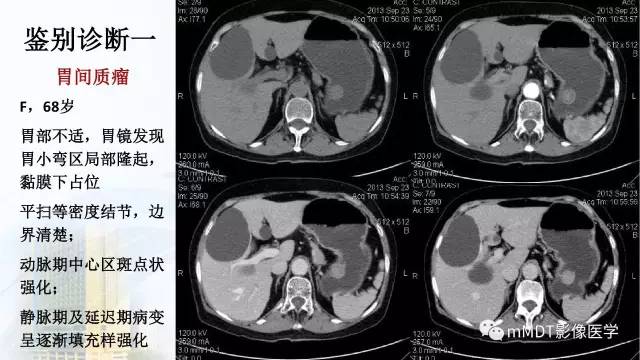 【PPT】胃神经鞘瘤