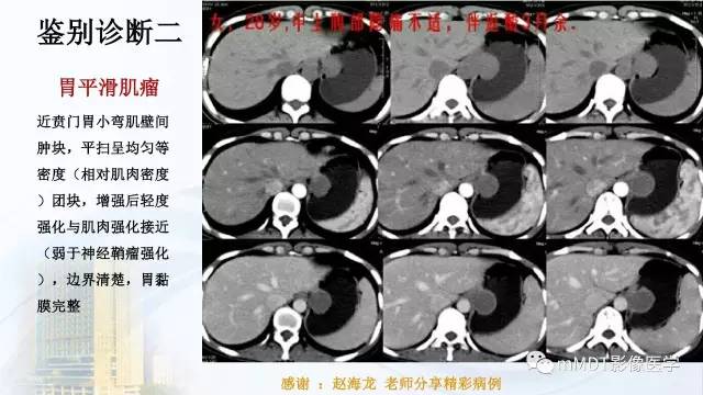 【PPT】胃神经鞘瘤
