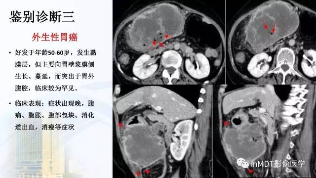 【PPT】胃神经鞘瘤