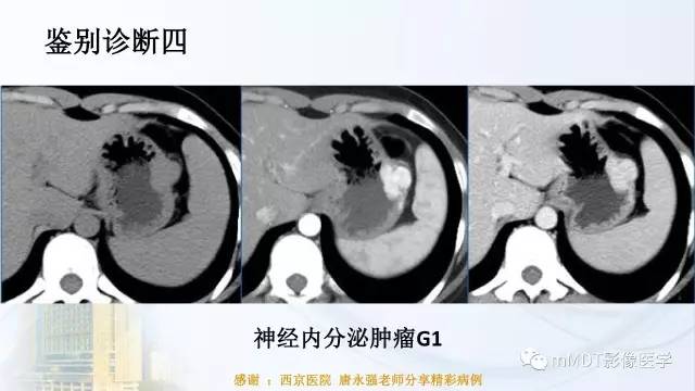 【PPT】胃神经鞘瘤