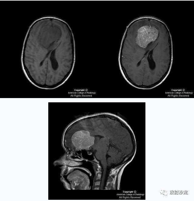 【双语病例】嗅沟脑膜瘤1例CT及MR 【双语病例】嗅沟脑膜瘤1例CT及MR