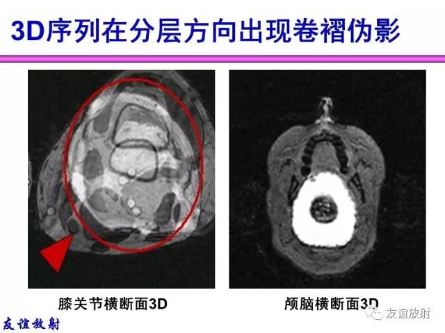 【PPT】MRI伪影与对策