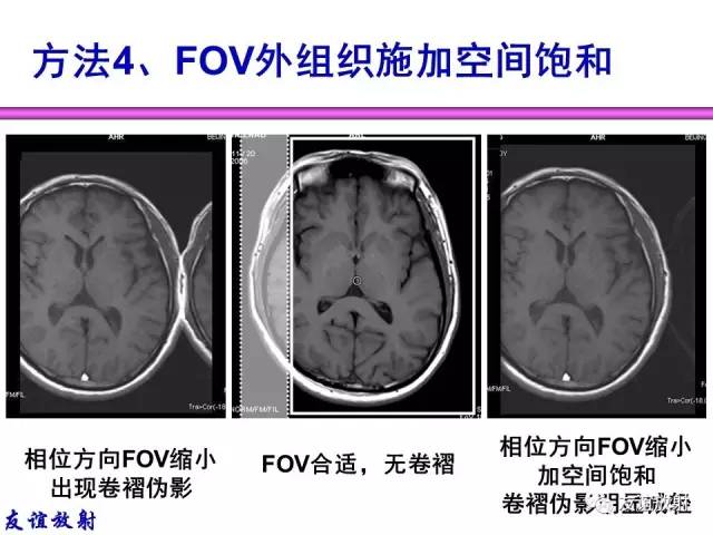 【PPT】MRI伪影与对策