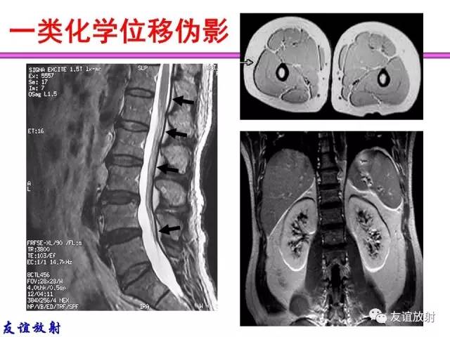【PPT】MRI伪影与对策