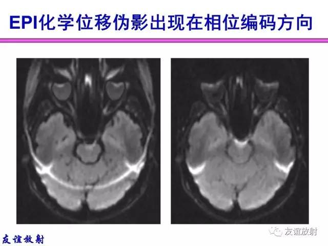 【PPT】MRI伪影与对策