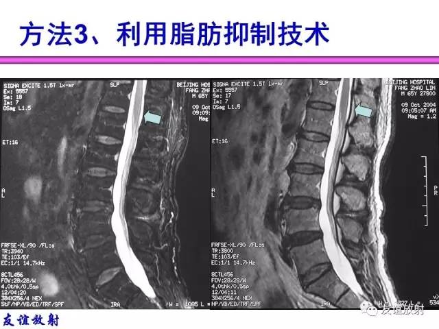 【PPT】MRI伪影与对策
