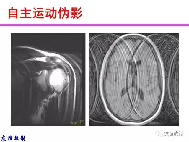 【PPT】MRI伪影与对策