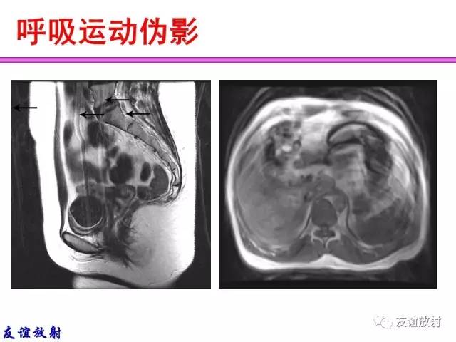 【PPT】MRI伪影与对策